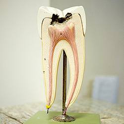 Tooth Model