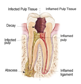 Infected Tooth Illustration