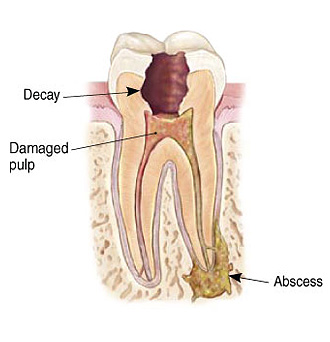 Infected Tooth Illustration