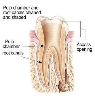 Cleaning Root Canals Illustration